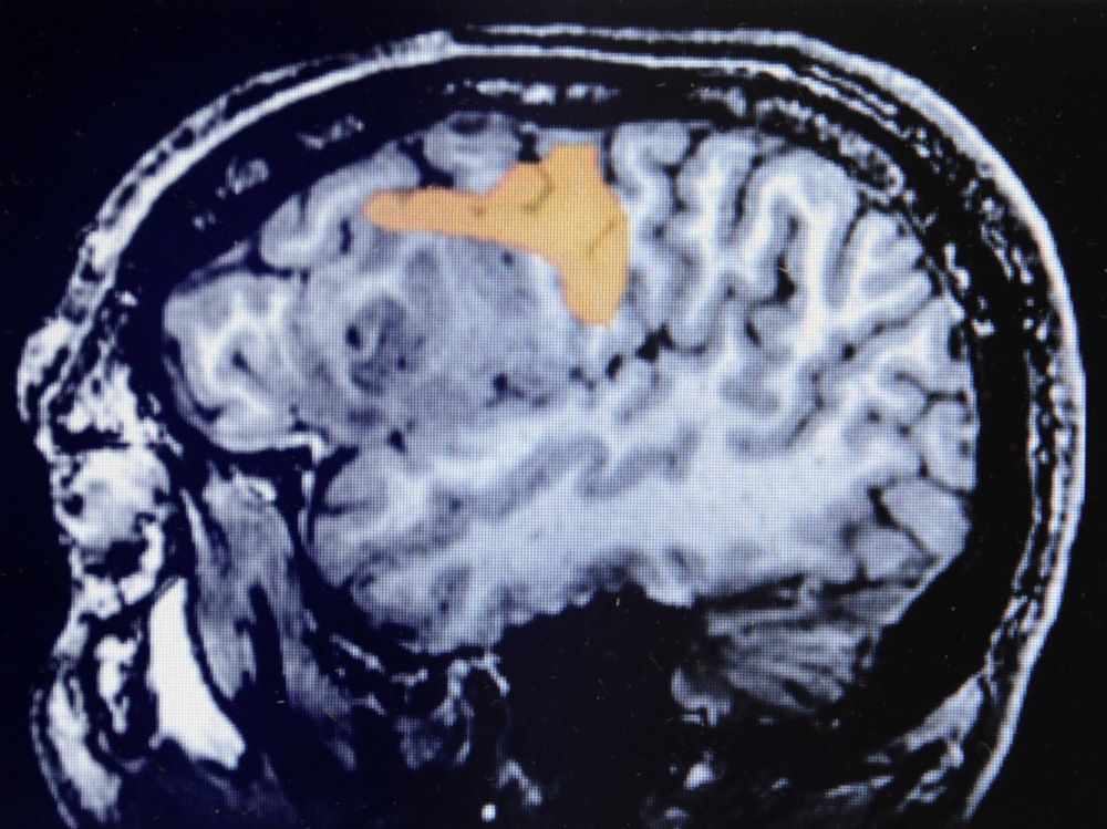 Glioblastome : un vaccin double la survie globale des patients