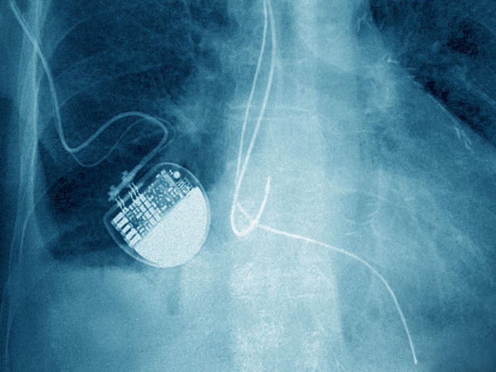 “Implant files” : une enquête internationale accable les implants médicaux