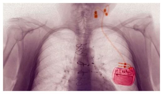 Des chercheurs redonnent la conscience à une personne dans le coma depuis 15 ans